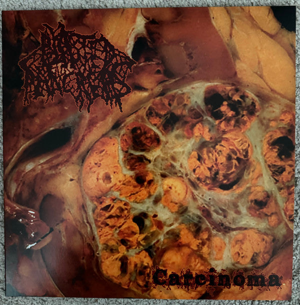 BLASTED PANCREAS - CARCINOMA